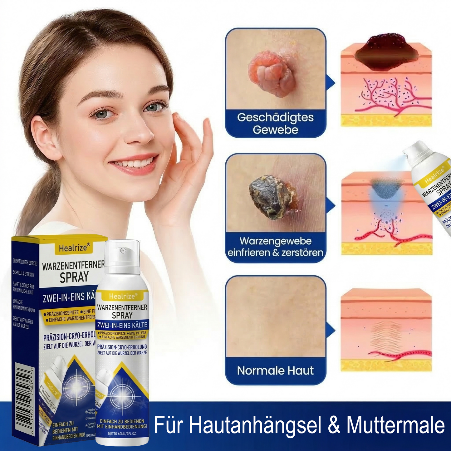 Healrize® Kälte-Spray zur Warzen-Erneuerung &amp; Korrektur——Z