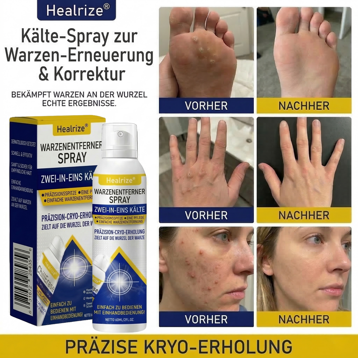 Healrize® Kälte-Spray zur Warzen-Erneuerung &amp; Korrektur——Z