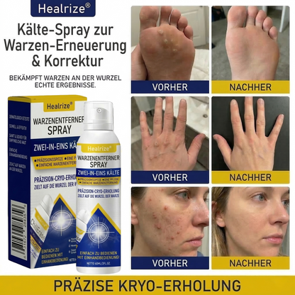 Healrize® Kälte-Spray zur Warzen-Erneuerung &amp; Korrektur——Z