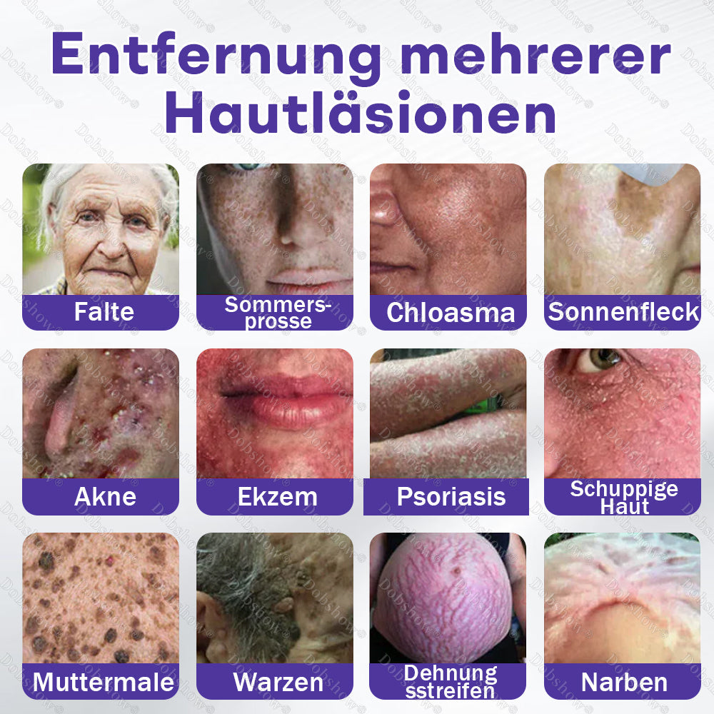 ⭐Dobshow® Mikronadelpflaster gegen Warzen und Muttermale
