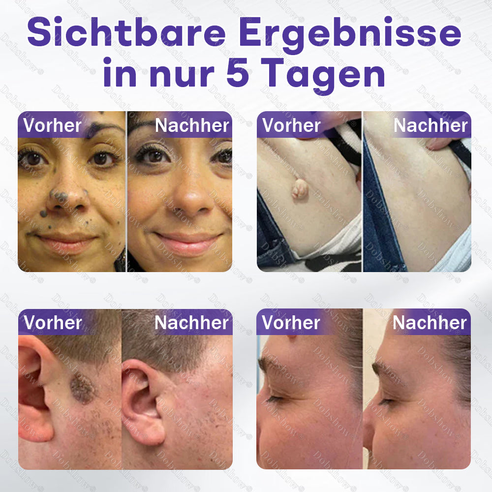 ⭐Dobshow® Mikronadelpflaster gegen Warzen und Muttermale