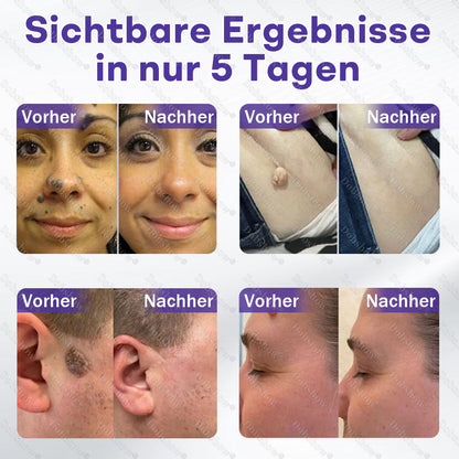 ⭐Dobshow® Mikronadelpflaster gegen Warzen und Muttermale