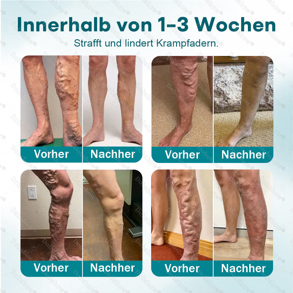 👨‍⚕️✅Healrize® Schnelle Venen-Linderung Microdarts | Sichtbare Resultate in nur 7 Tagen – Für JEDEN HAUTTYP ✨