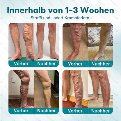 👨‍⚕️✅Healrize® Schnelle Venen-Linderung Microdarts | Sichtbare Resultate in nur 7 Tagen – Für JEDEN HAUTTYP ✨