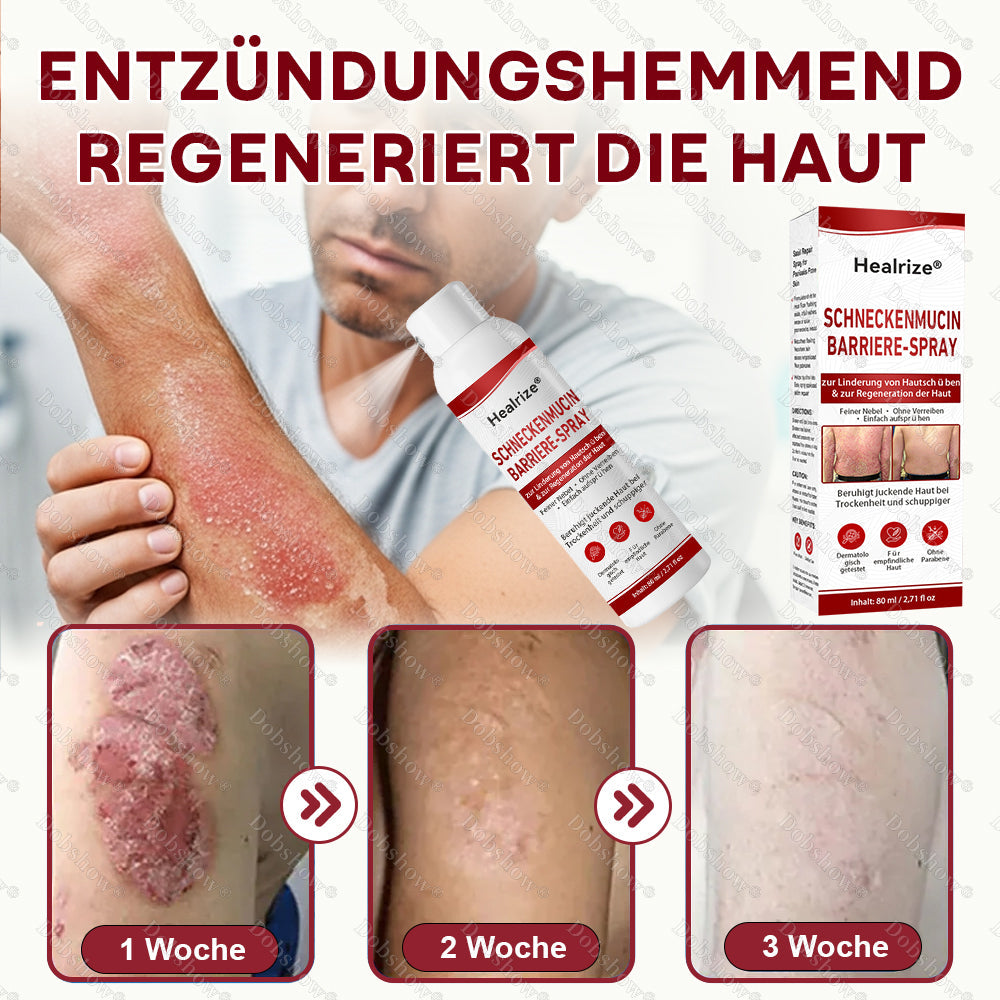 ⭐ Bestseller | Healrize® Schneckenmucin-Barriere-Spray zur Linderung von Hautschüben und zur Regeneration der Haut-𝘿𝙚𝙪𝙩𝙨𝙘𝙝𝙡𝙖𝙣𝙙𝙨 𝙉𝙧. 1 𝙨𝙥𝙧ü𝙝𝙗𝙖𝙧𝙚 𝘽𝙖𝙧𝙧𝙞𝙚𝙧𝙚-𝙋𝙛𝙡𝙚𝙜𝙚 𝙗𝙚𝙞 𝙋𝙨𝙤𝙧𝙞𝙖𝙨𝙞𝙨✨