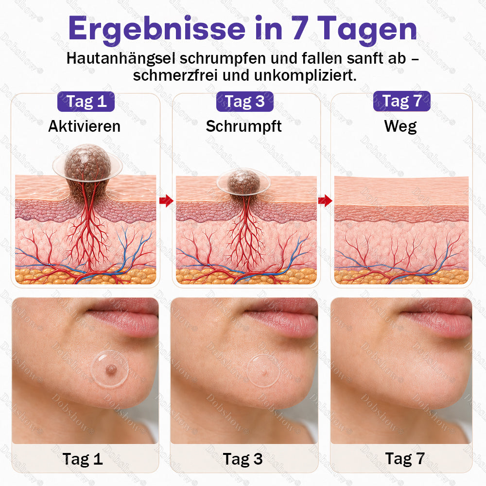 ⭐Dobshow® Mikronadelpflaster gegen Warzen und Muttermale