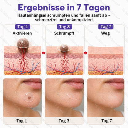 ⭐Dobshow® Mikronadelpflaster gegen Warzen und Muttermale